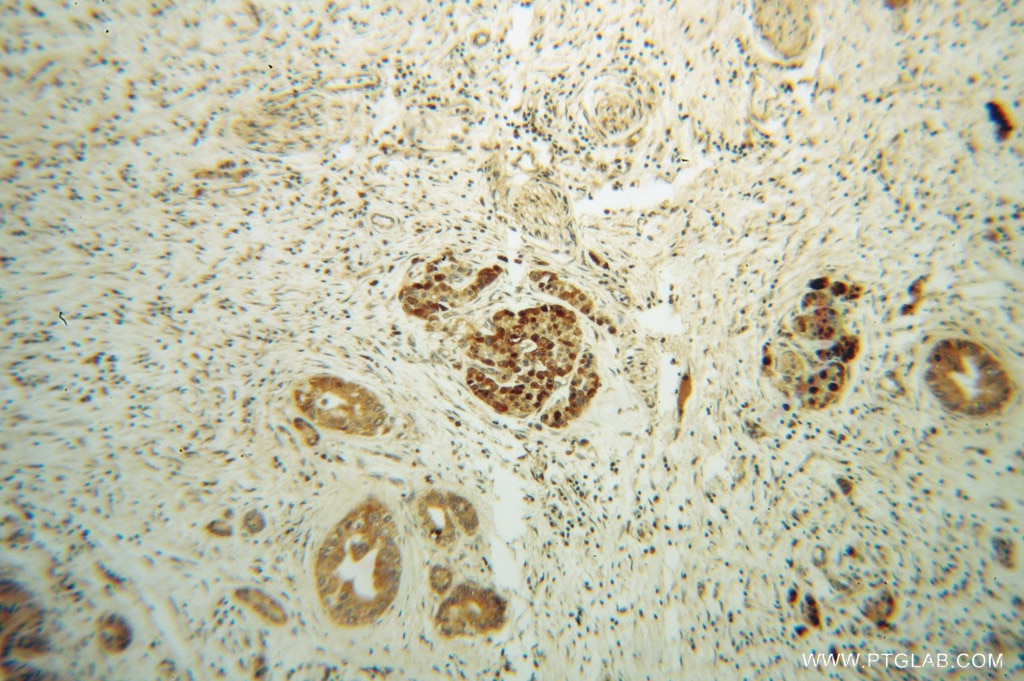 Immunohistochemistry (IHC) staining of human pancreas cancer tissue using ZADH2 Polyclonal antibody (14679-1-AP)