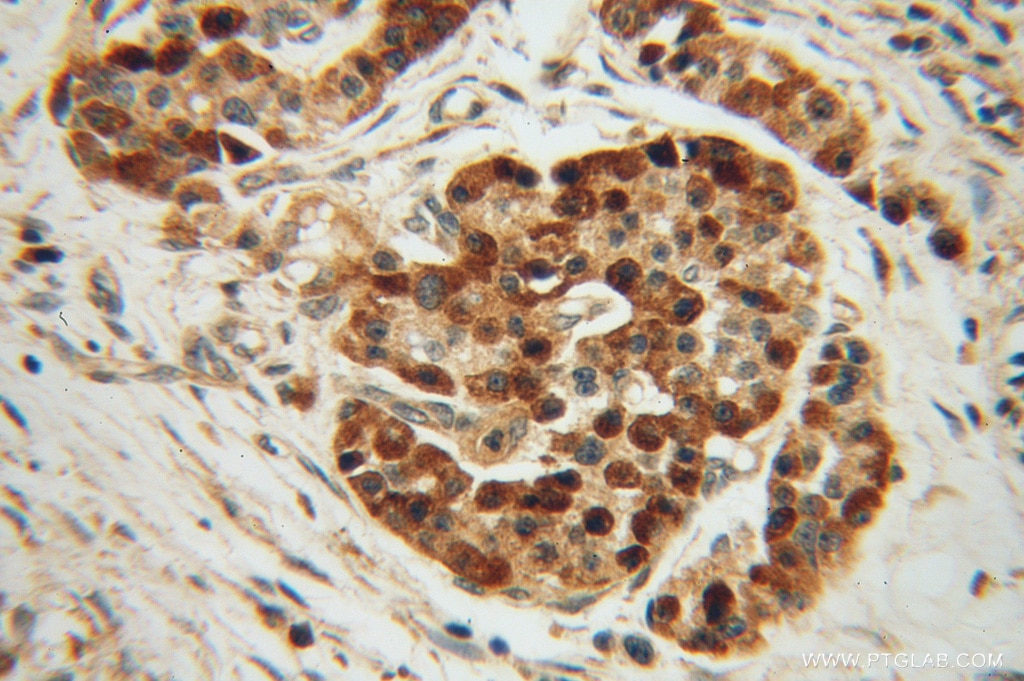 Immunohistochemistry (IHC) staining of human pancreas cancer tissue using ZADH2 Polyclonal antibody (14679-1-AP)