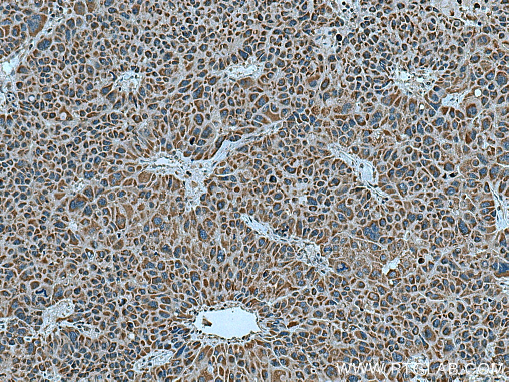 Immunohistochemistry (IHC) staining of human liver cancer tissue using ZAK Polyclonal antibody (14945-1-AP)
