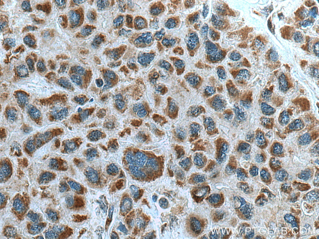 Immunohistochemistry (IHC) staining of human liver cancer tissue using ZAK Polyclonal antibody (14945-1-AP)