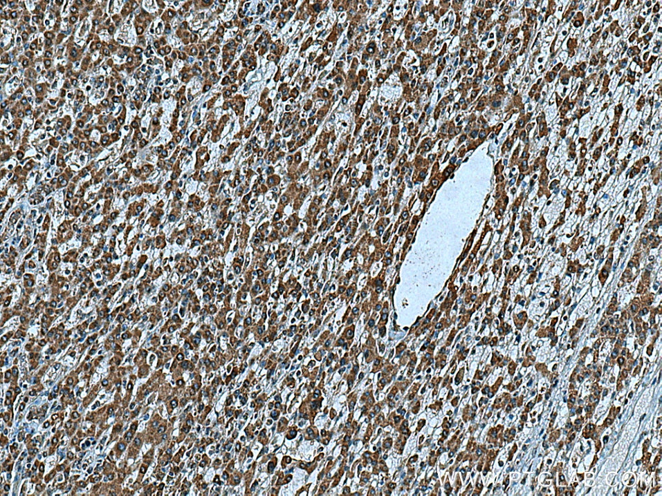 Immunohistochemistry (IHC) staining of human liver cancer tissue using ZAK Polyclonal antibody (14945-1-AP)