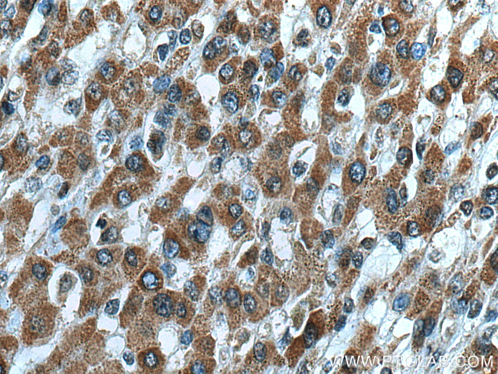 Immunohistochemistry (IHC) staining of human liver cancer tissue using ZAK Polyclonal antibody (14945-1-AP)