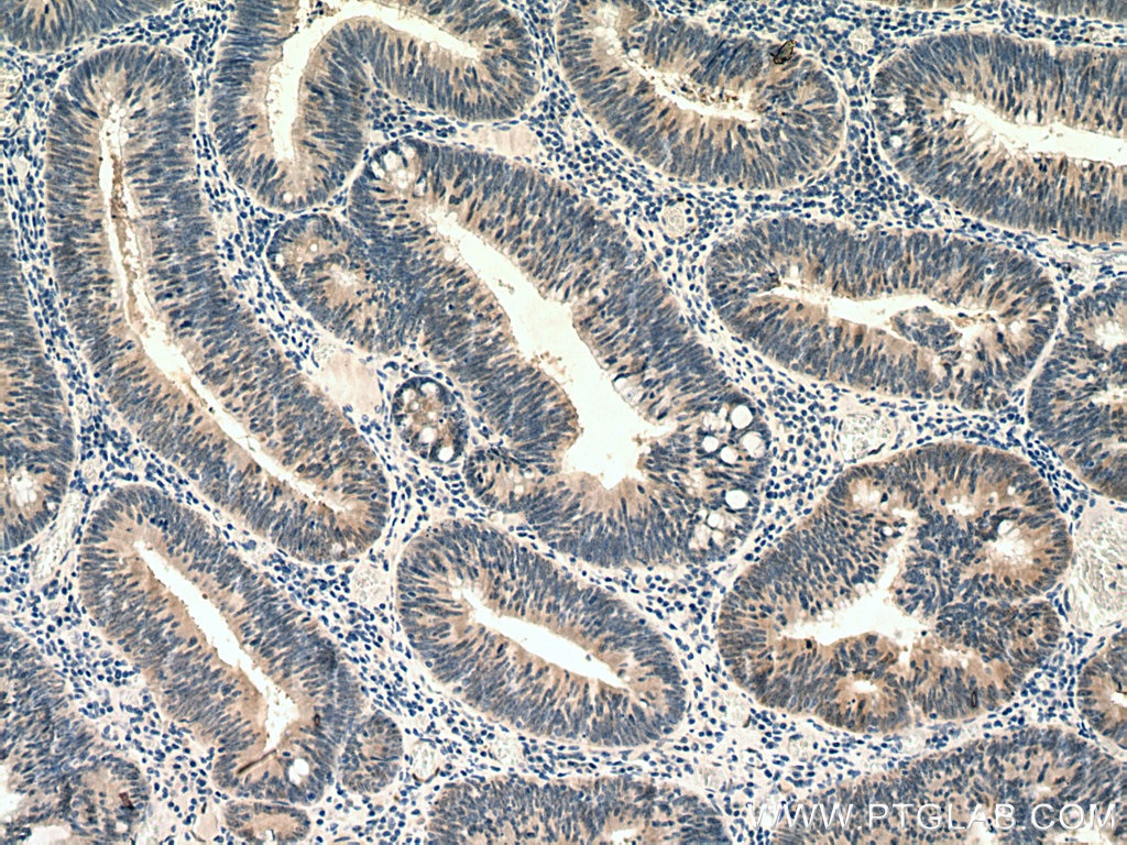 Immunohistochemistry (IHC) staining of human colon cancer tissue using ZAK Polyclonal antibody (28761-1-AP)