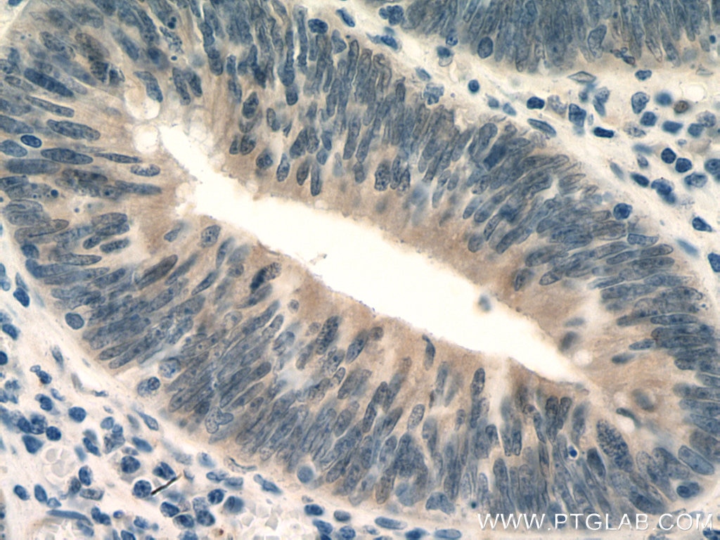 Immunohistochemistry (IHC) staining of human colon cancer tissue using ZAK Polyclonal antibody (28761-1-AP)