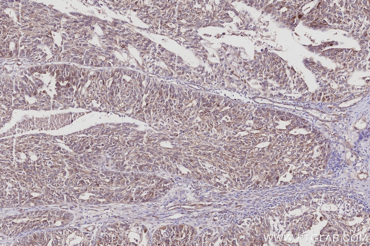 Immunohistochemistry (IHC) staining of human ovary cancer tissue using ZAK Polyclonal antibody (28761-1-AP)