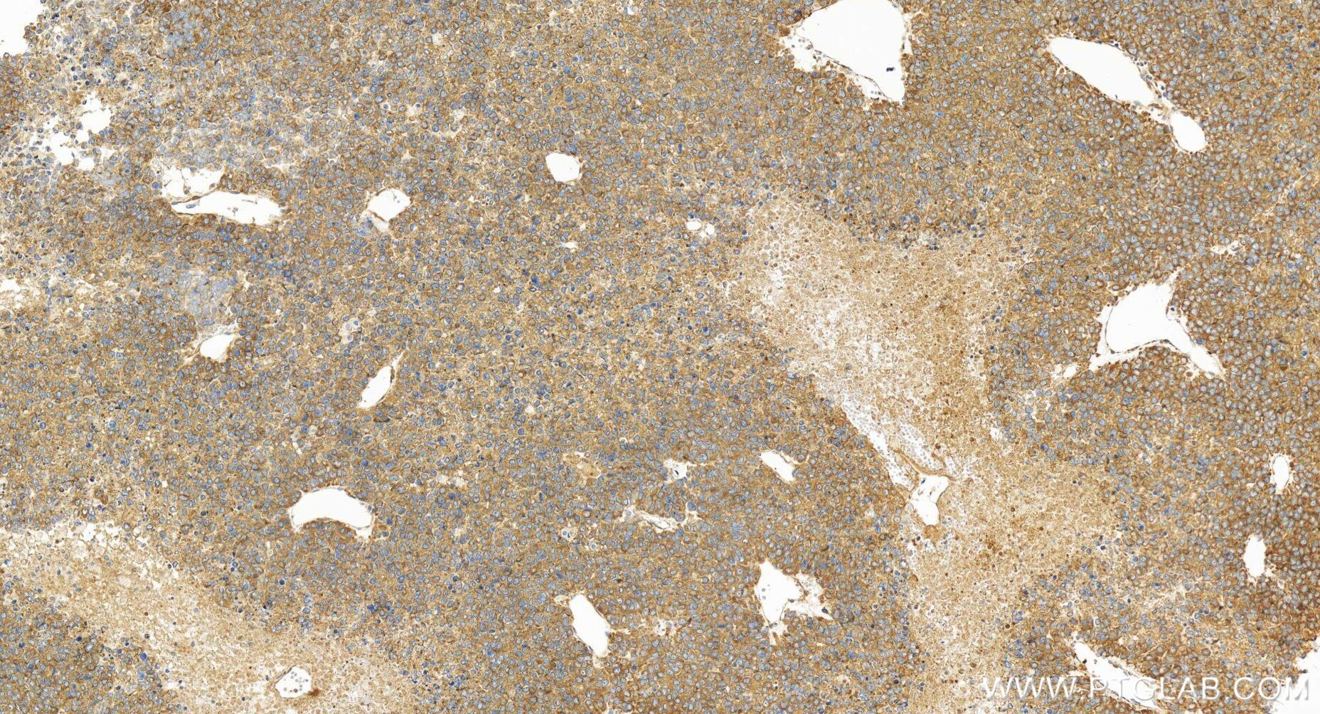 Immunohistochemistry (IHC) staining of human liver cancer tissue using ZAK Recombinant antibody (81161-3-RR)