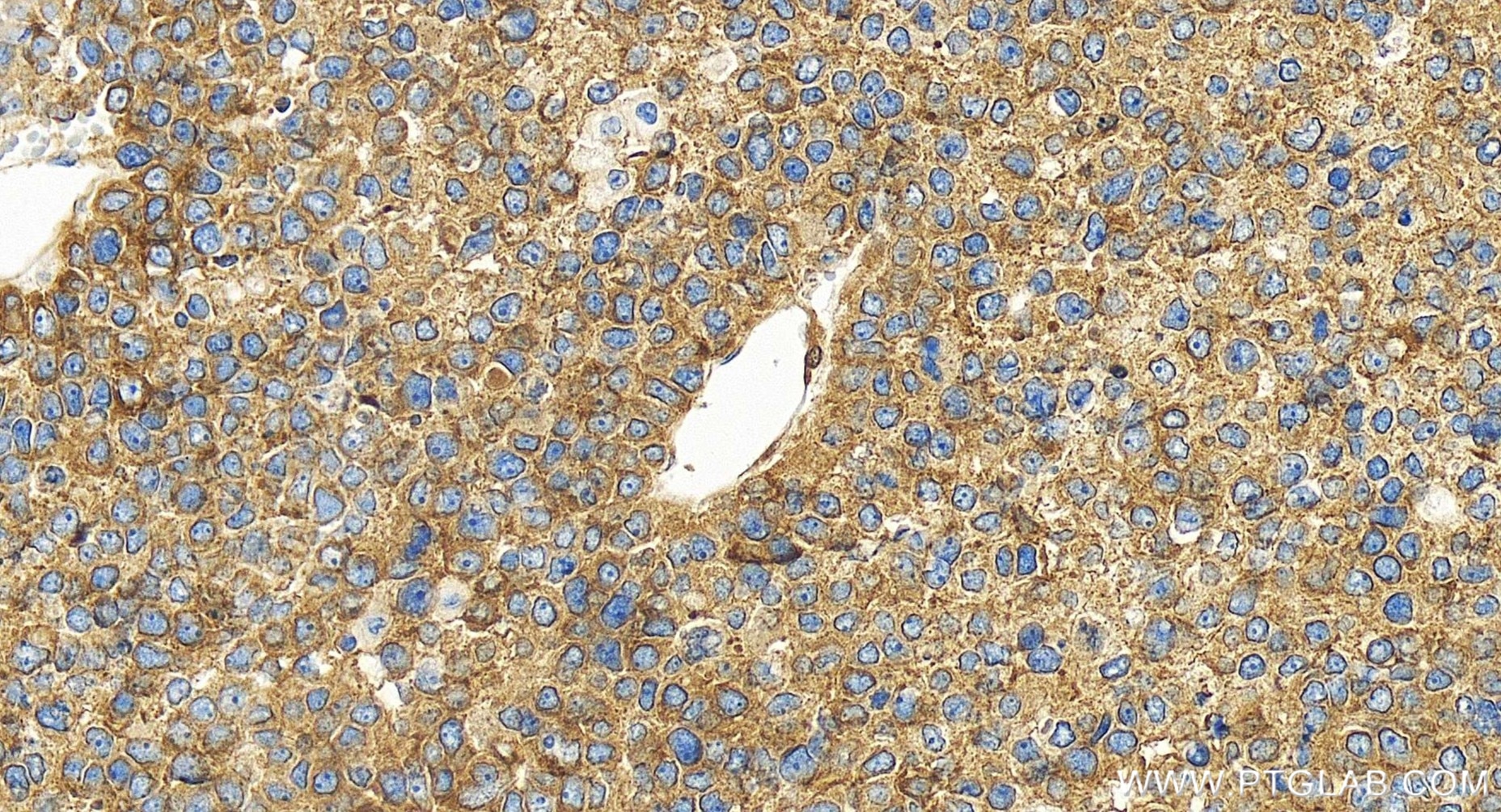 Immunohistochemistry (IHC) staining of human liver cancer tissue using ZAK Recombinant antibody (81161-3-RR)