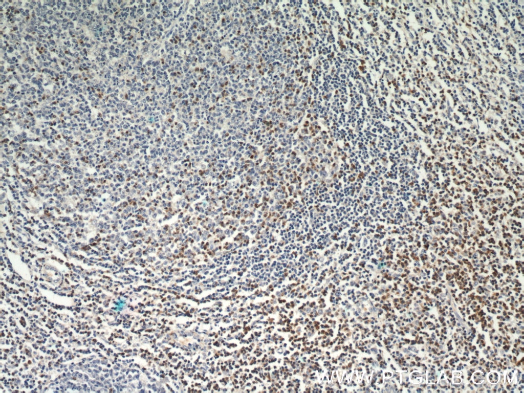 Immunohistochemistry (IHC) staining of human tonsillitis tissue using ZAP70 Polyclonal antibody (15592-1-AP)