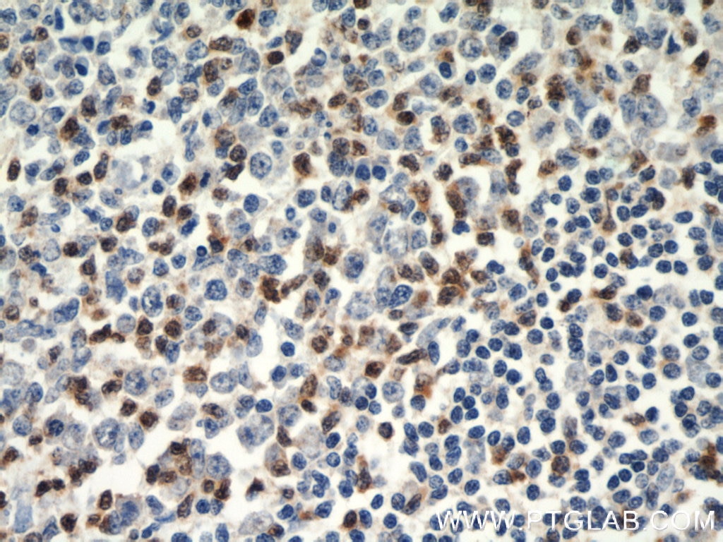 Immunohistochemistry (IHC) staining of human tonsillitis tissue using ZAP70 Polyclonal antibody (15592-1-AP)