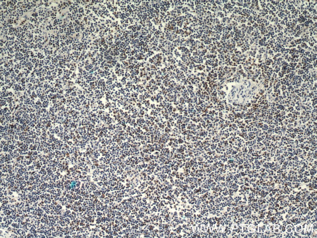 Immunohistochemistry (IHC) staining of human lymphoma tissue using ZAP70 Polyclonal antibody (15592-1-AP)