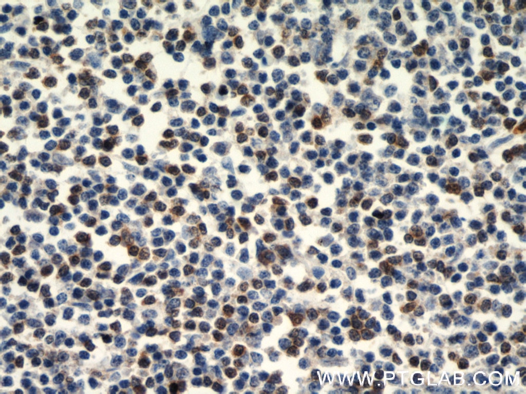 Immunohistochemistry (IHC) staining of human lymphoma tissue using ZAP70 Polyclonal antibody (15592-1-AP)
