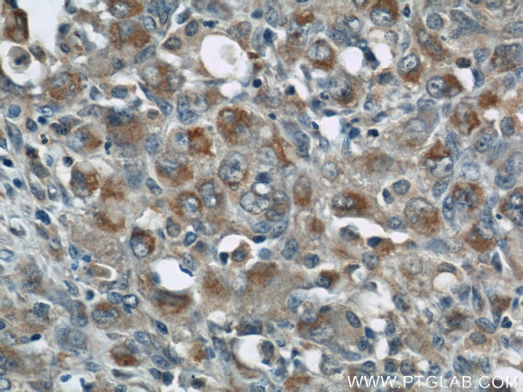 Immunohistochemistry (IHC) staining of human lymphoma tissue using ZAP70 Polyclonal antibody (22207-1-AP)