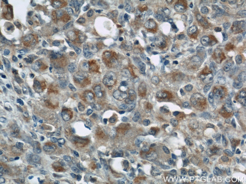 IHC staining of human lymphoma using 22207-1-AP