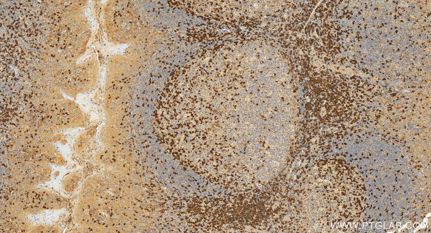 Immunohistochemistry (IHC) staining of human tonsillitis tissue using ZAP70 Polyclonal antibody (22207-1-AP)