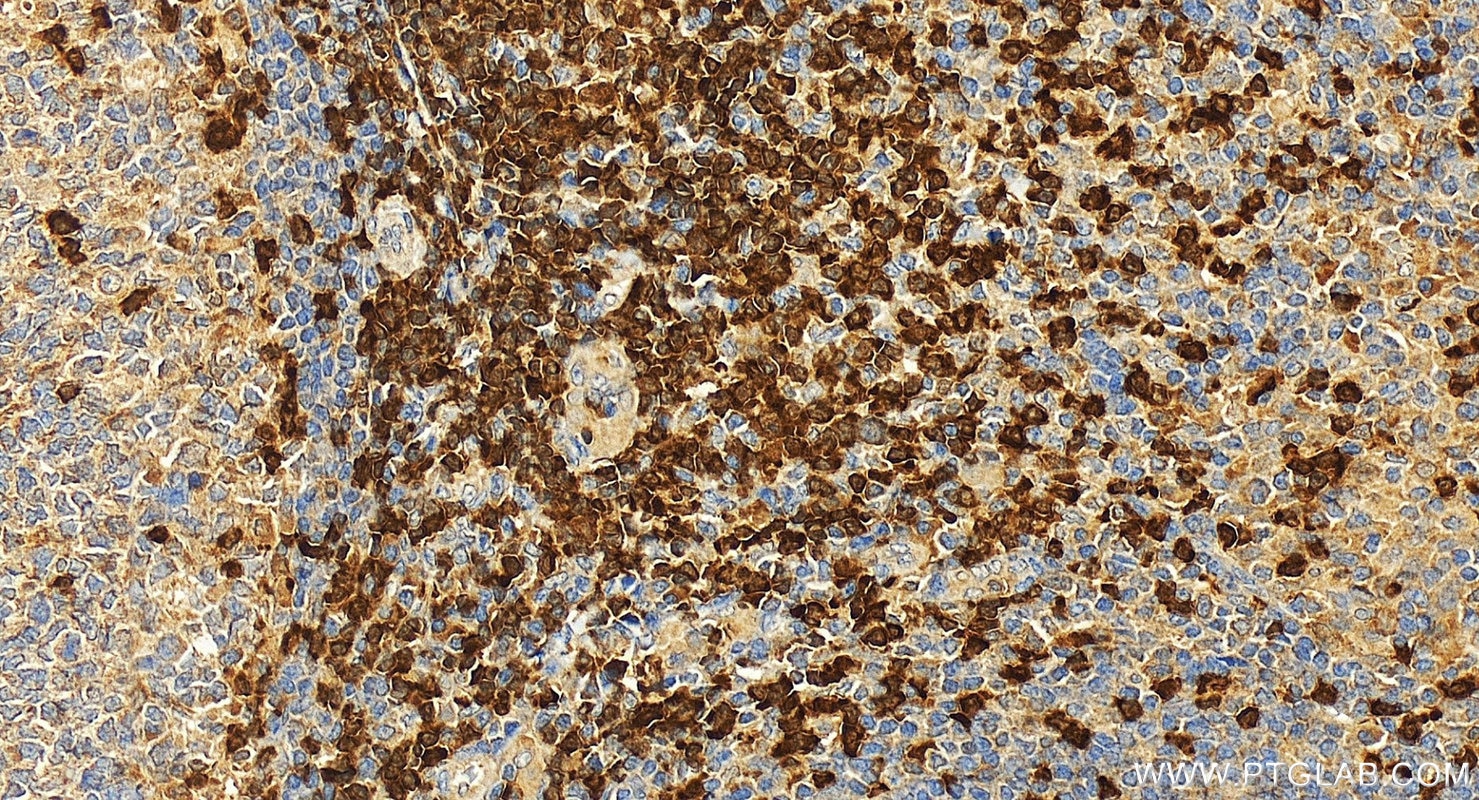 Immunohistochemistry (IHC) staining of human tonsillitis tissue using ZAP70 Polyclonal antibody (22207-1-AP)