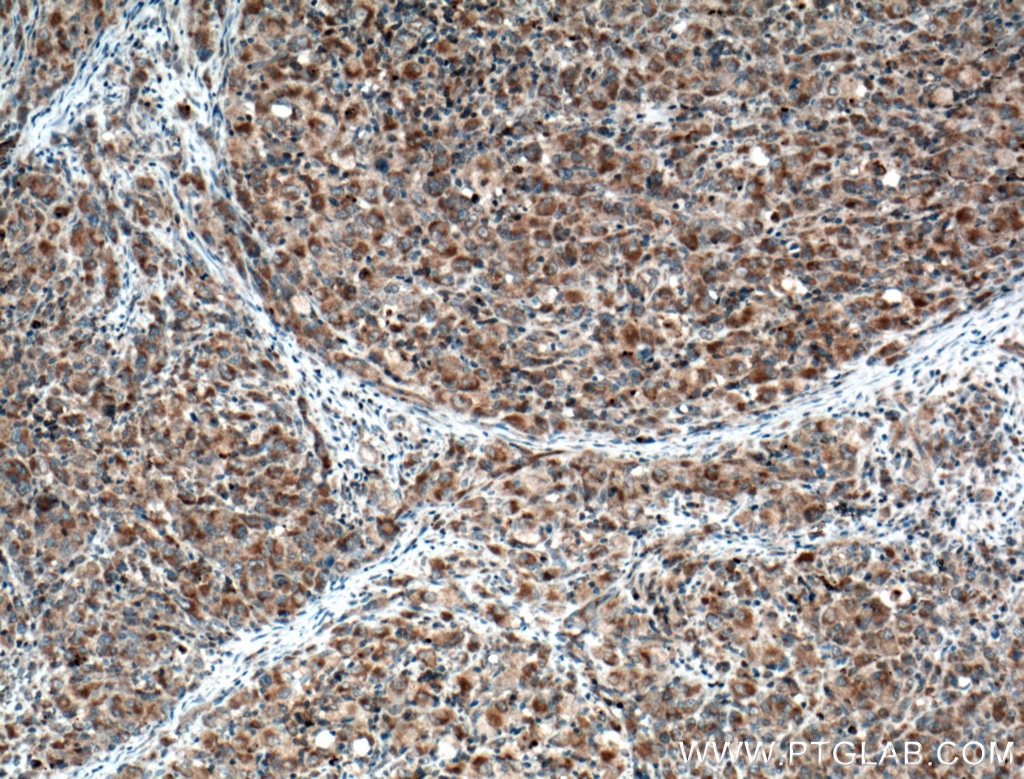 Immunohistochemistry (IHC) staining of human lymphoma tissue using ZAP70 Monoclonal antibody (60200-1-Ig)