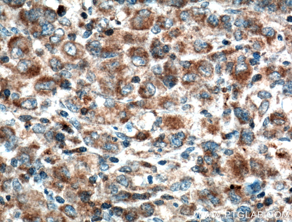 IHC staining of human lymphoma using 60200-1-Ig