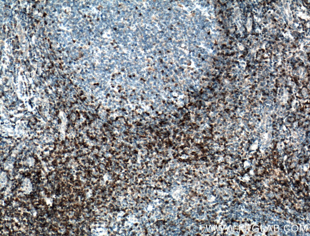 Immunohistochemistry (IHC) staining of human tonsillitis tissue using ZAP70 Monoclonal antibody (60200-1-Ig)