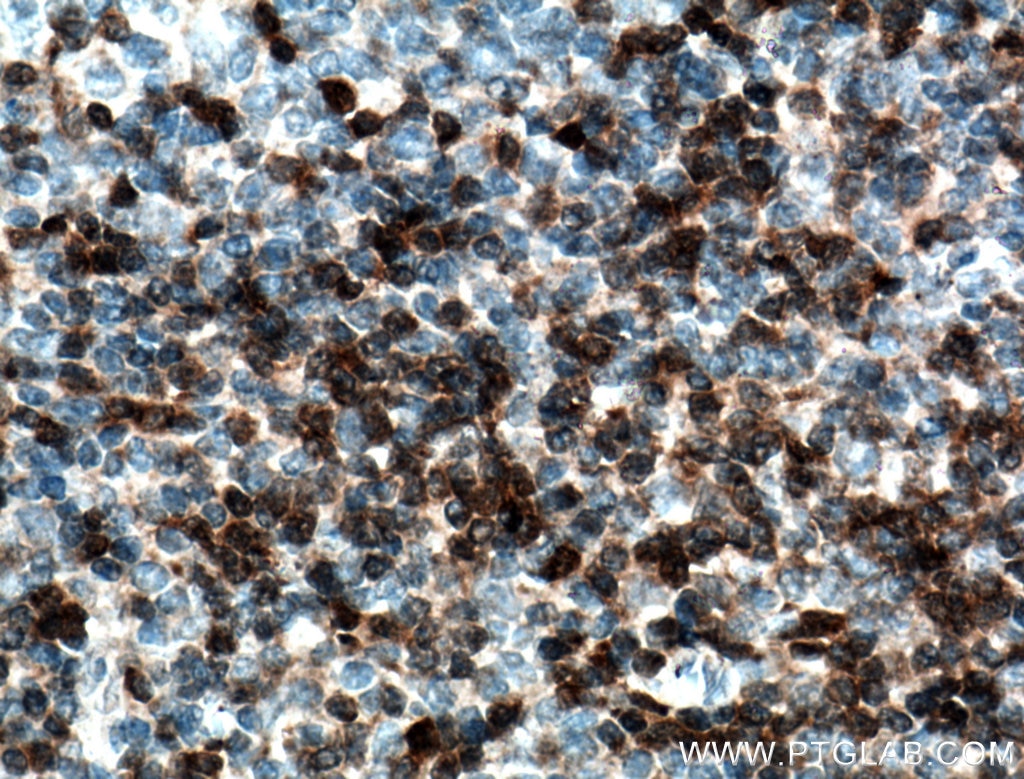 Immunohistochemistry (IHC) staining of human tonsillitis tissue using ZAP70 Monoclonal antibody (60200-1-Ig)