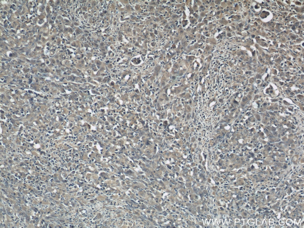 Immunohistochemistry (IHC) staining of human lymphoma tissue using ZAP70 Monoclonal antibody (60200-2-Ig)