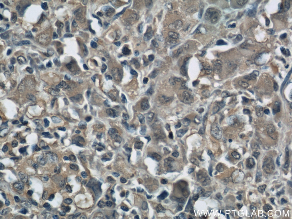 Immunohistochemistry (IHC) staining of human lymphoma tissue using ZAP70 Monoclonal antibody (60200-2-Ig)