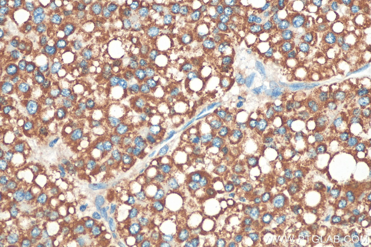 Immunohistochemistry (IHC) staining of human liver cancer tissue using ZBP1 Polyclonal antibody (13285-1-AP)