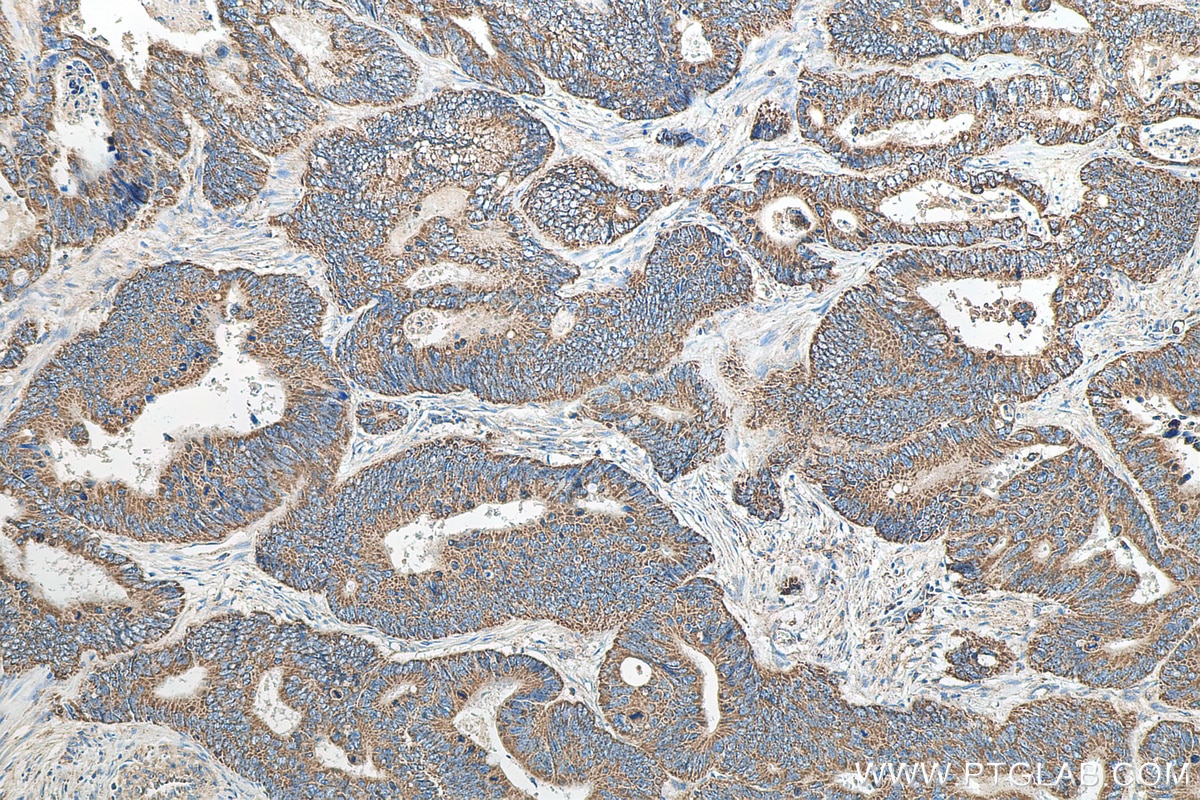 Immunohistochemistry (IHC) staining of human colon cancer tissue using ZBP1 Polyclonal antibody (13285-1-AP)