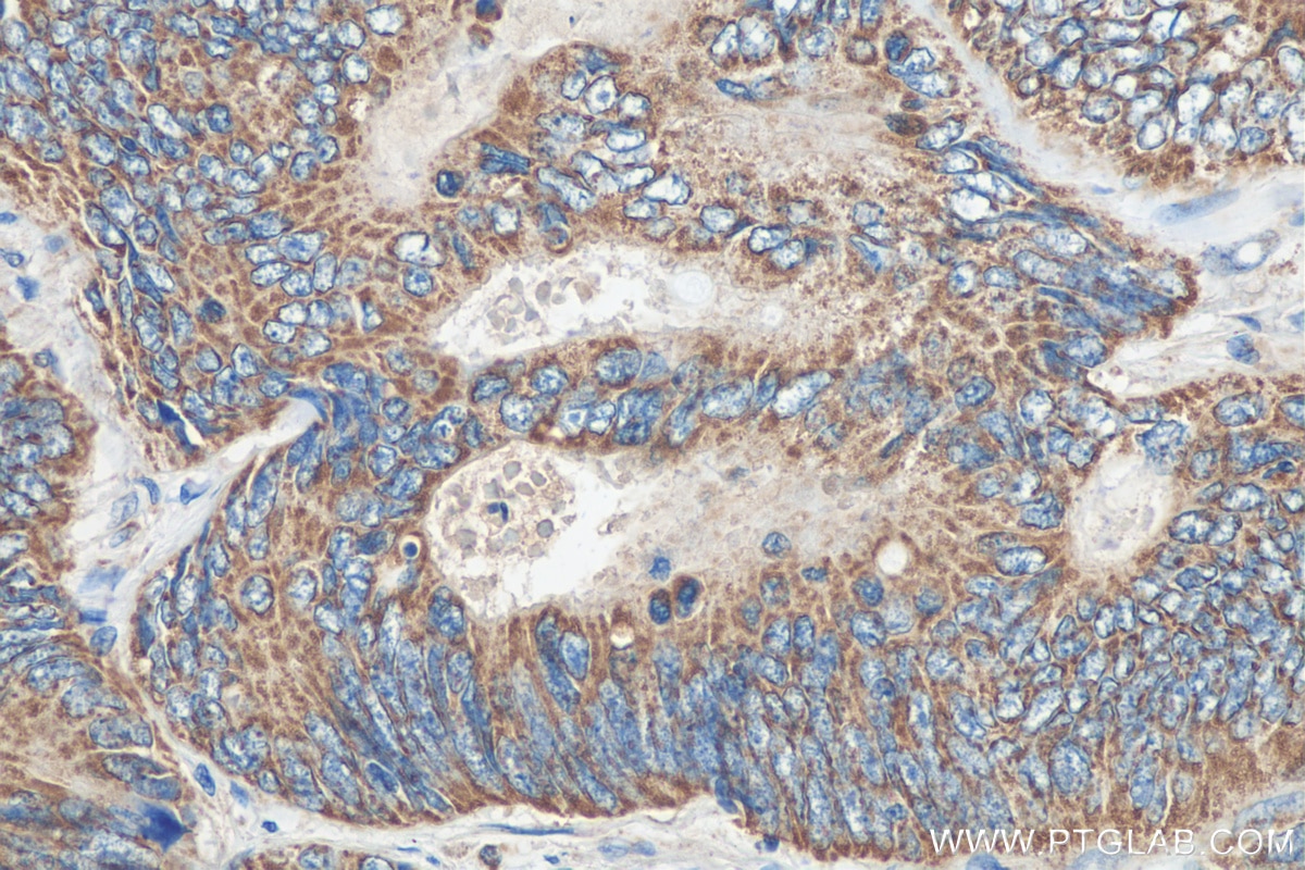 Immunohistochemistry (IHC) staining of human colon cancer tissue using ZBP1 Polyclonal antibody (13285-1-AP)