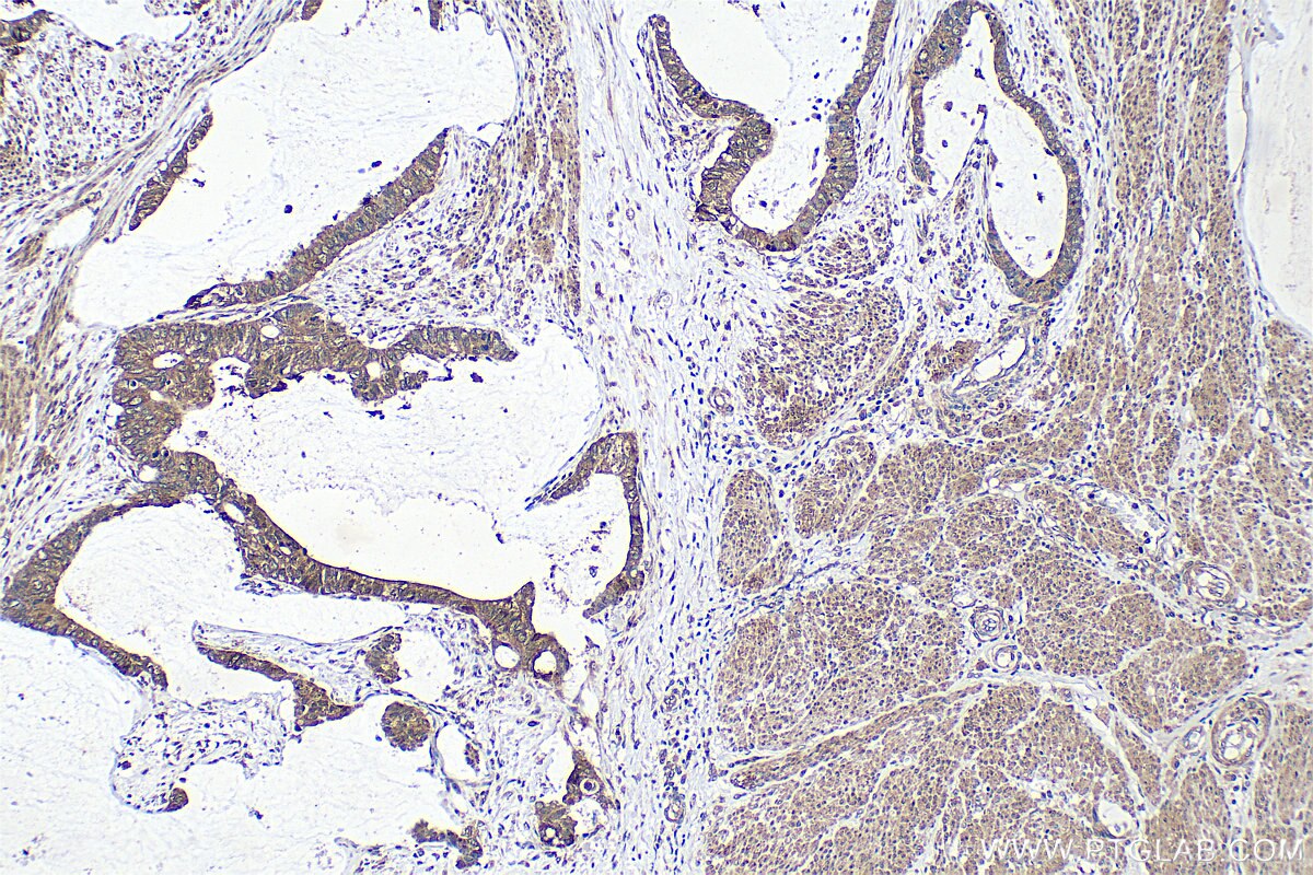 Immunohistochemistry (IHC) staining of human urothelial carcinoma tissue using ZBTB11 Polyclonal antibody (25215-1-AP)