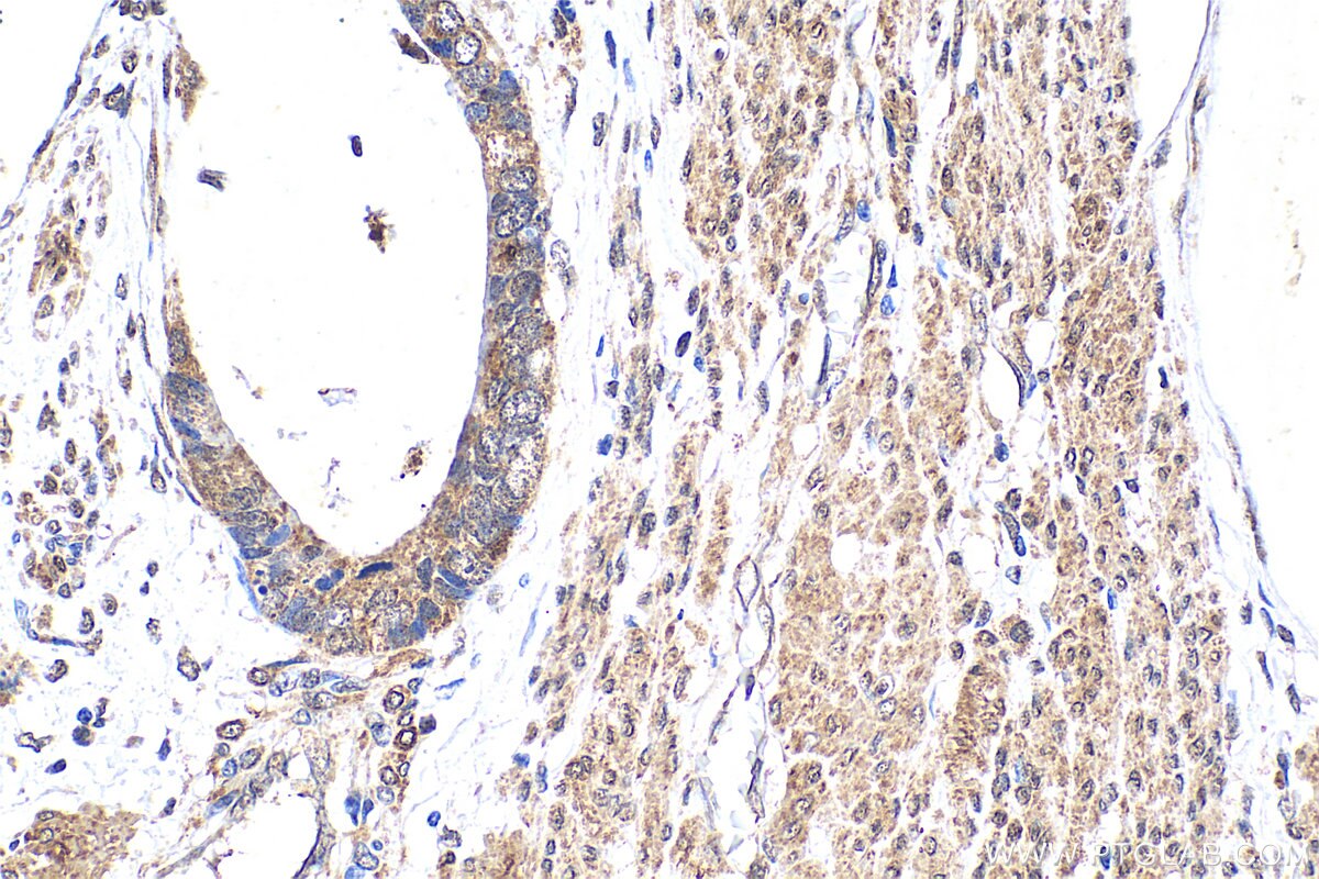 Immunohistochemistry (IHC) staining of human urothelial carcinoma tissue using ZBTB11 Polyclonal antibody (25215-1-AP)