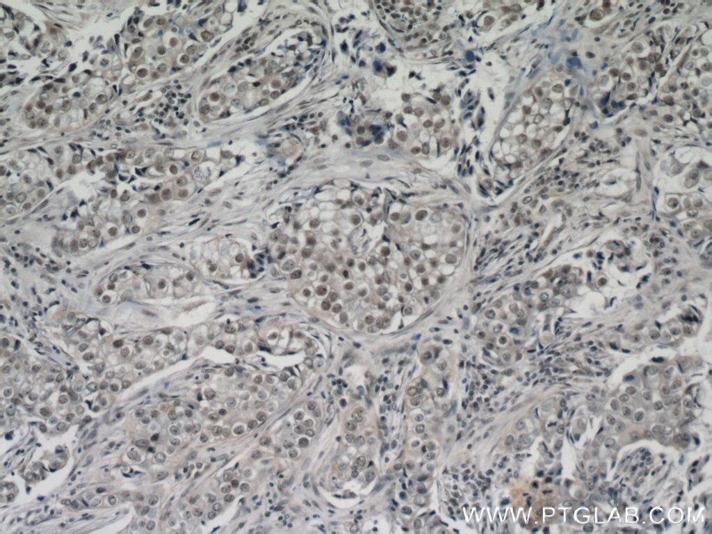 Immunohistochemistry (IHC) staining of human breast cancer tissue using ZBTB38 Polyclonal antibody (21906-1-AP)