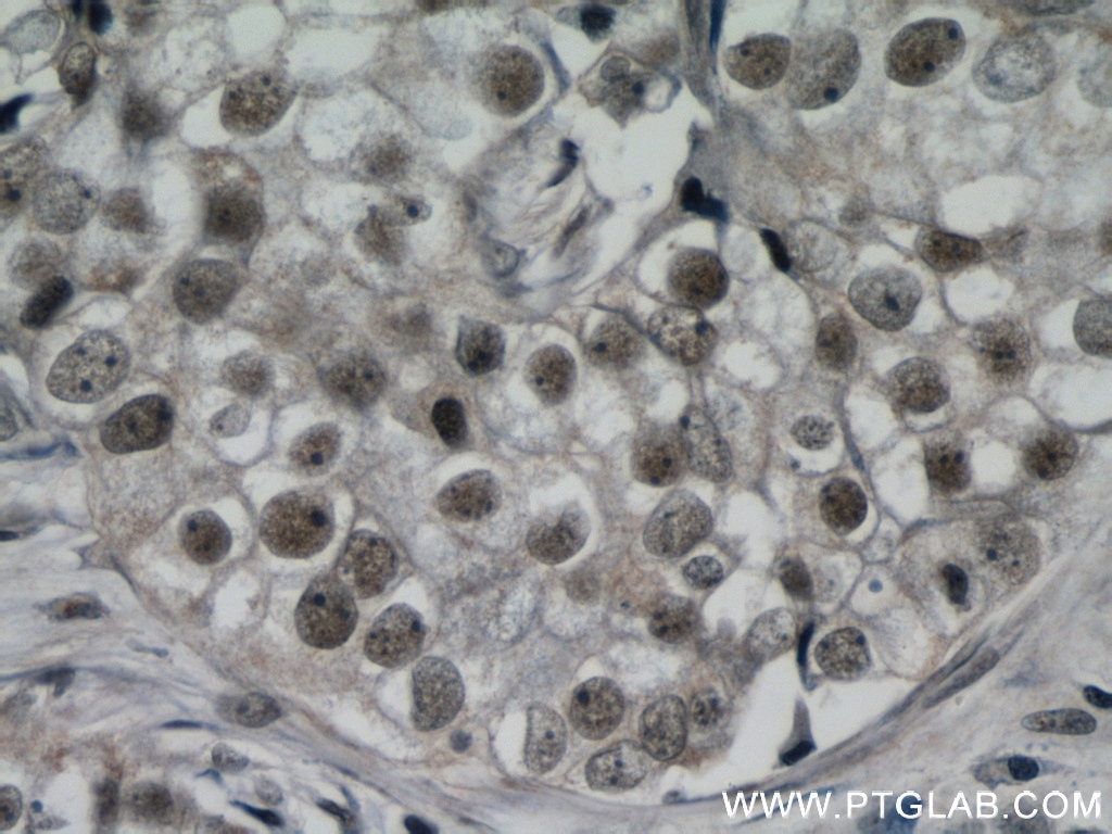 Immunohistochemistry (IHC) staining of human breast cancer tissue using ZBTB38 Polyclonal antibody (21906-1-AP)