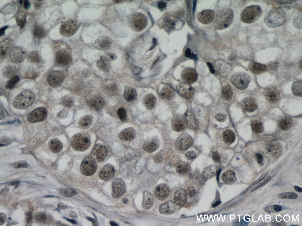 IHC staining of human breast cancer using 21906-1-AP