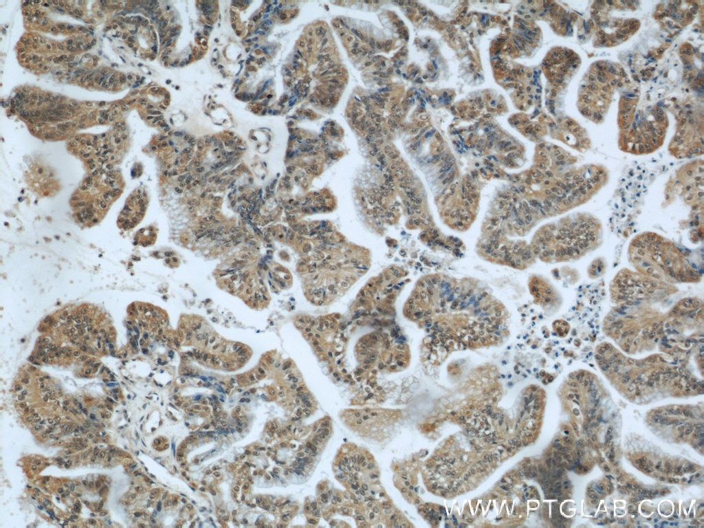 Immunohistochemistry (IHC) staining of human ovary tumor tissue using ZBTB38 Polyclonal antibody (21906-1-AP)