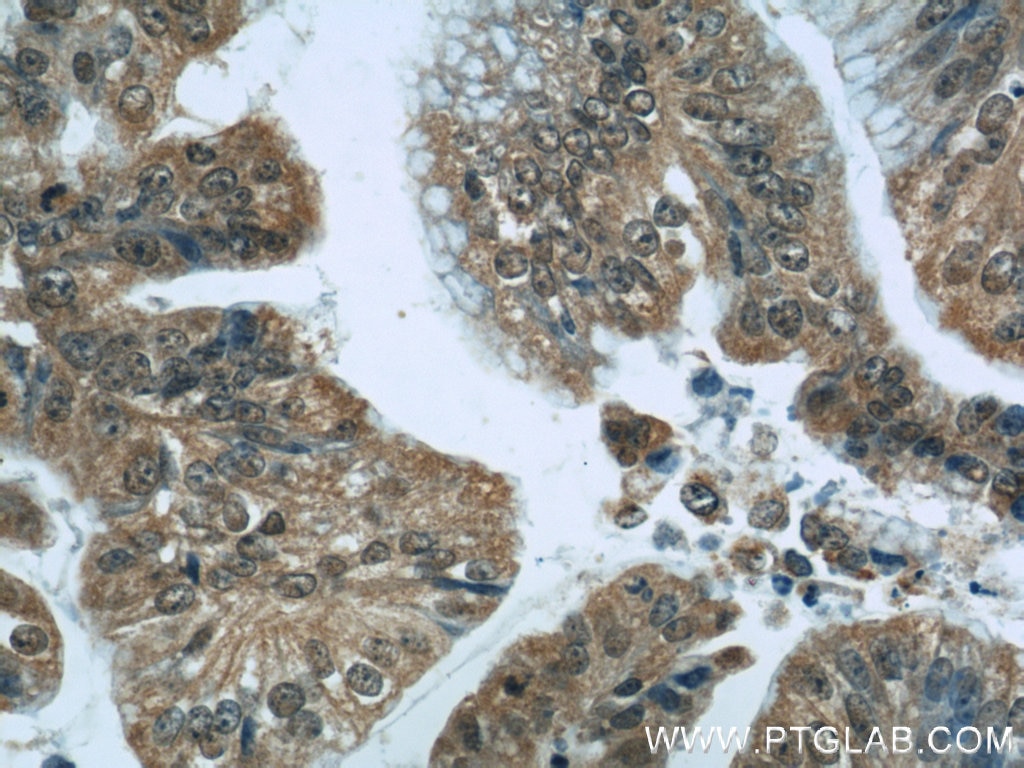 IHC staining of human ovary tumor using 21906-1-AP