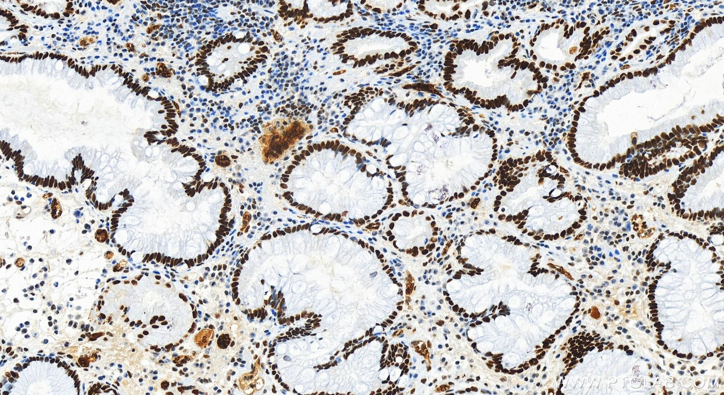 Immunohistochemistry (IHC) staining of human stomach cancer tissue using ZBTB7A Recombinant antibody (83616-5-RR)