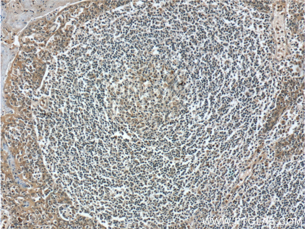 Immunohistochemistry (IHC) staining of human tonsillitis tissue using ZC3H12D Polyclonal antibody (24991-1-AP)