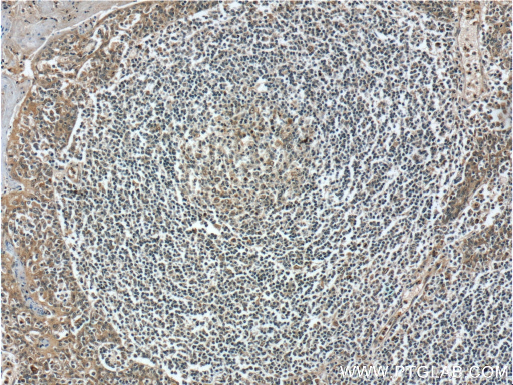 IHC staining of human tonsillitis using 24991-1-AP