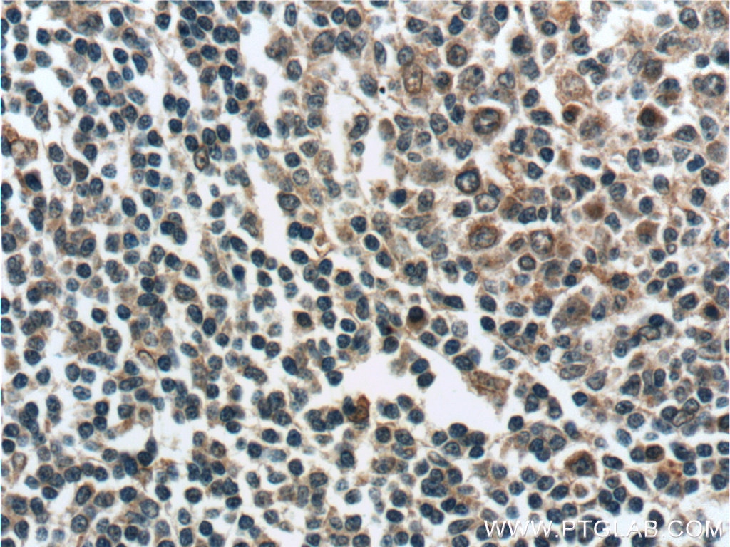 Immunohistochemistry (IHC) staining of human tonsillitis tissue using ZC3H12D Polyclonal antibody (24991-1-AP)