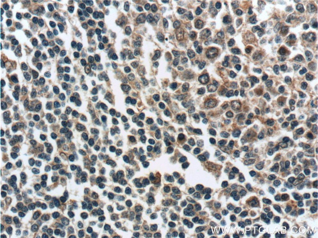 IHC staining of human tonsillitis using 24991-1-AP