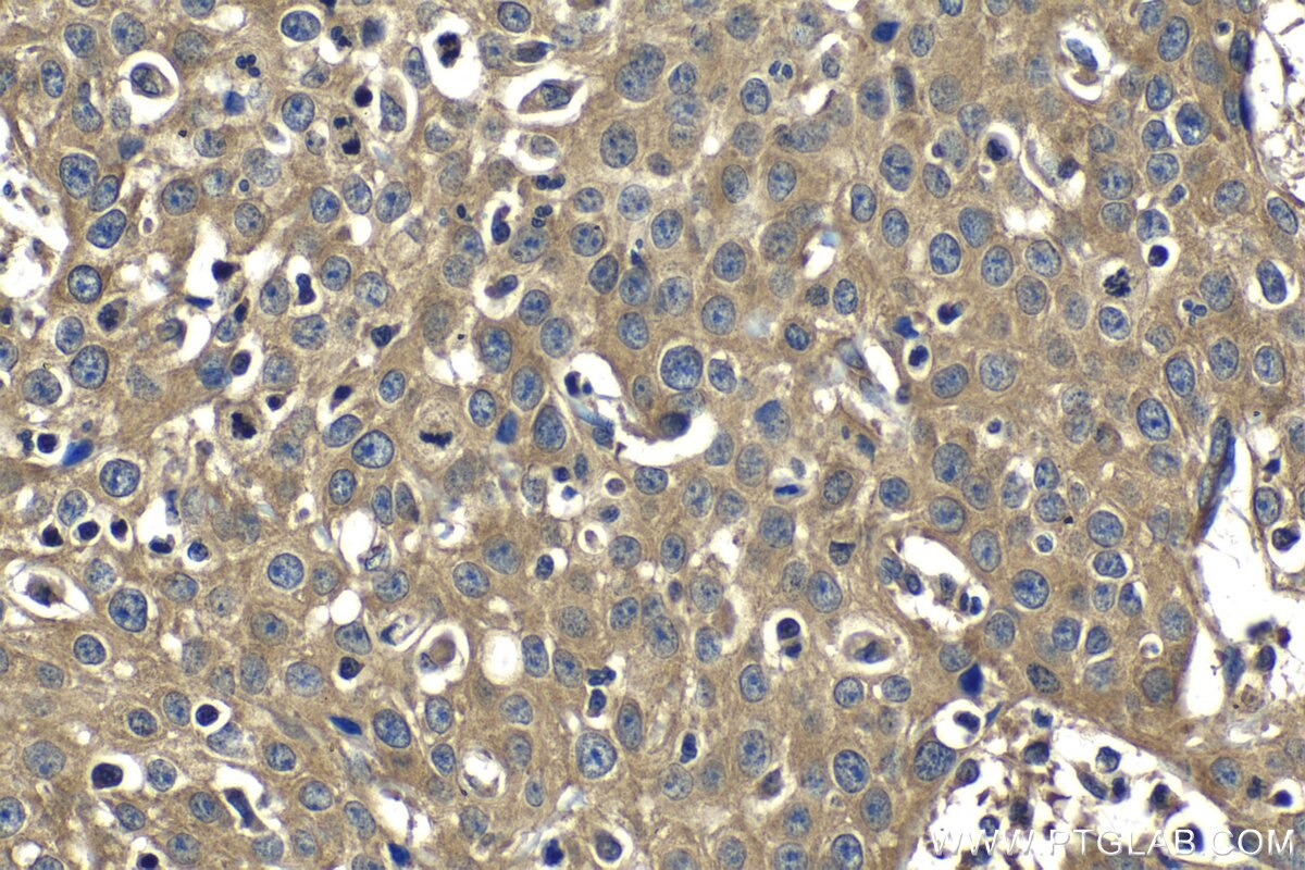 Immunohistochemistry (IHC) staining of human cervical cancer tissue using ZC3H15 Polyclonal antibody (26241-1-AP)