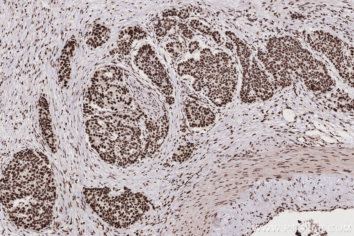 IHC staining of human stomach cancer using 25807-1-AP Immunohistochemistry (IHC) staining of human stomach cancer tissue using ZC3H18 Polyclonal antibody (25807-1-AP)