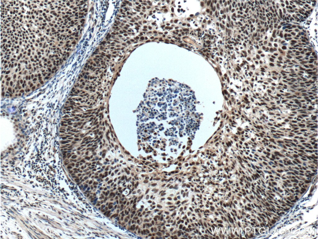 IHC staining of human cervical cancer using 25807-1-AP