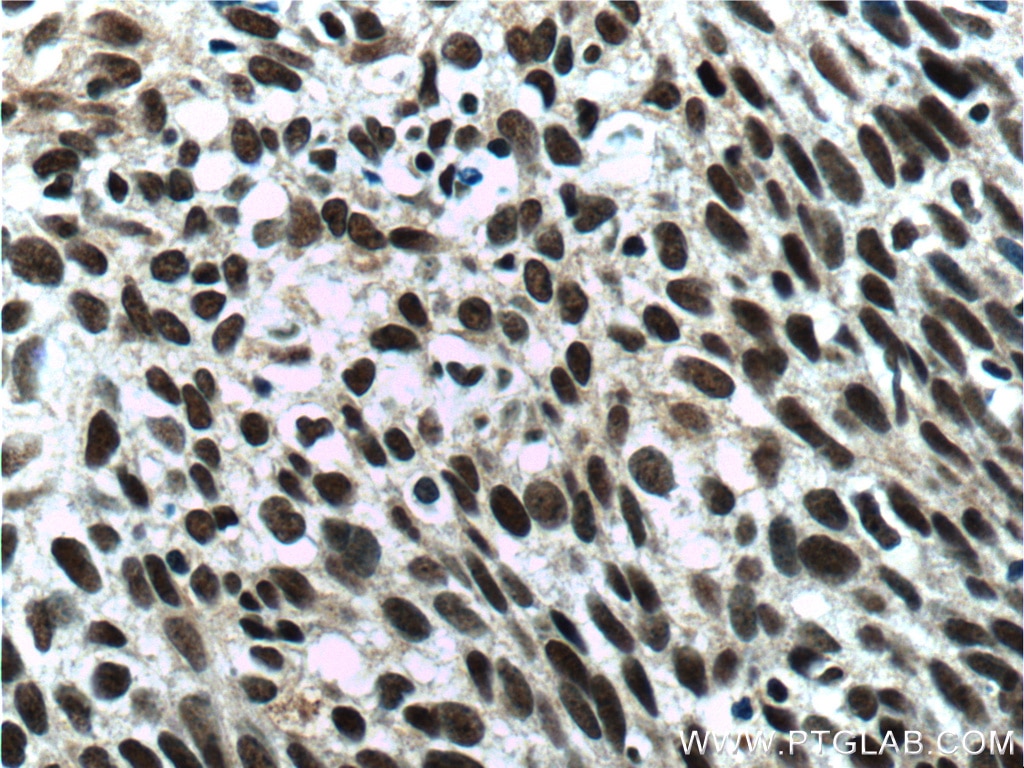 Immunohistochemistry (IHC) staining of human cervical cancer tissue using ZC3H18 Polyclonal antibody (25807-1-AP)