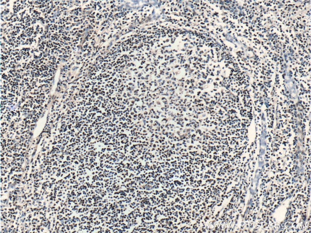 Immunohistochemistry (IHC) staining of human tonsillitis tissue using ZC3H18 Polyclonal antibody (25807-1-AP)