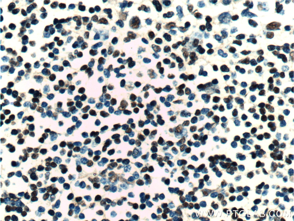 Immunohistochemistry (IHC) staining of human tonsillitis tissue using ZC3H18 Polyclonal antibody (25807-1-AP)