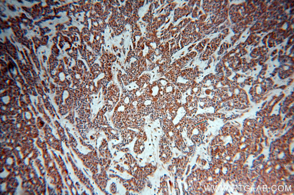 Immunohistochemistry (IHC) staining of human cervical cancer tissue using ZC3H4 Polyclonal antibody (20041-1-AP)