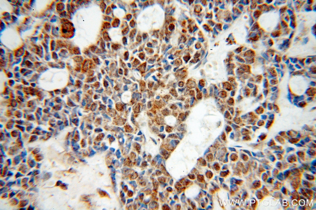 Immunohistochemistry (IHC) staining of human cervical cancer tissue using ZC3H4 Polyclonal antibody (20041-1-AP)