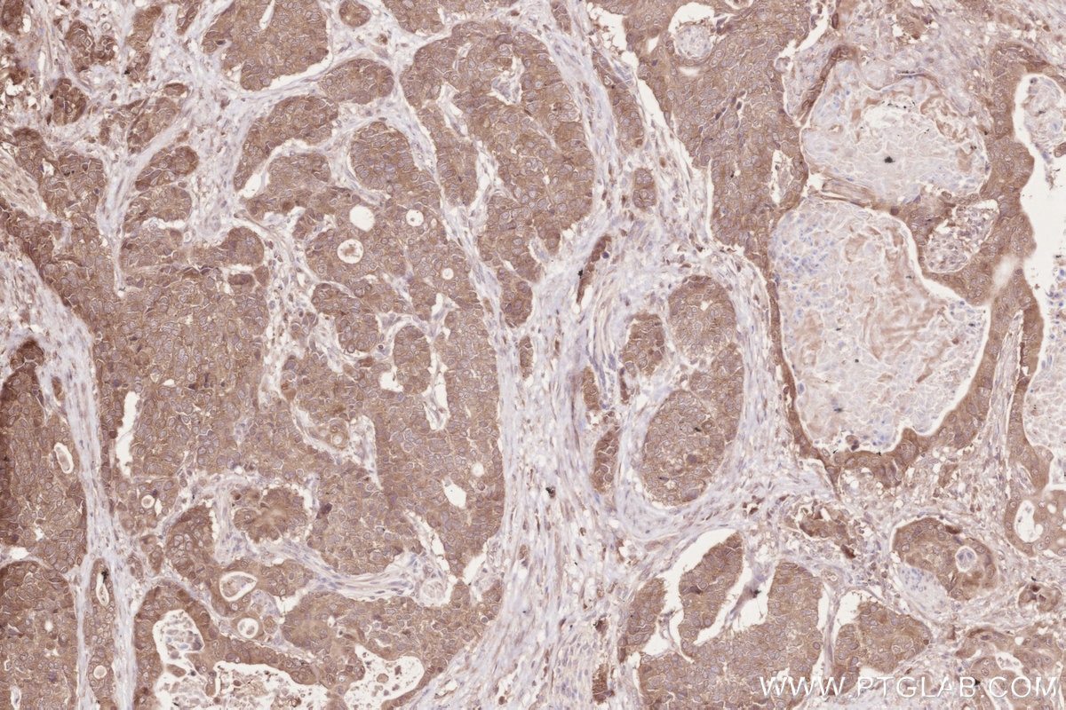 IHC staining of human stomach cancer using 16820-1-AP Immunohistochemistry (IHC) staining of human stomach cancer tissue using ZC3HAV1 Polyclonal antibody (16820-1-AP)