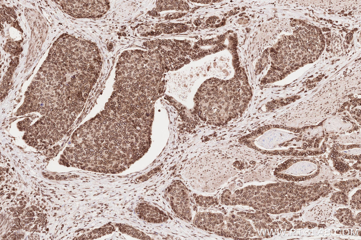 IHC staining of human stomach cancer using 13148-1-AP Immunohistochemistry (IHC) staining of human stomach cancer tissue using ZC3HC1 Polyclonal antibody (13148-1-AP)